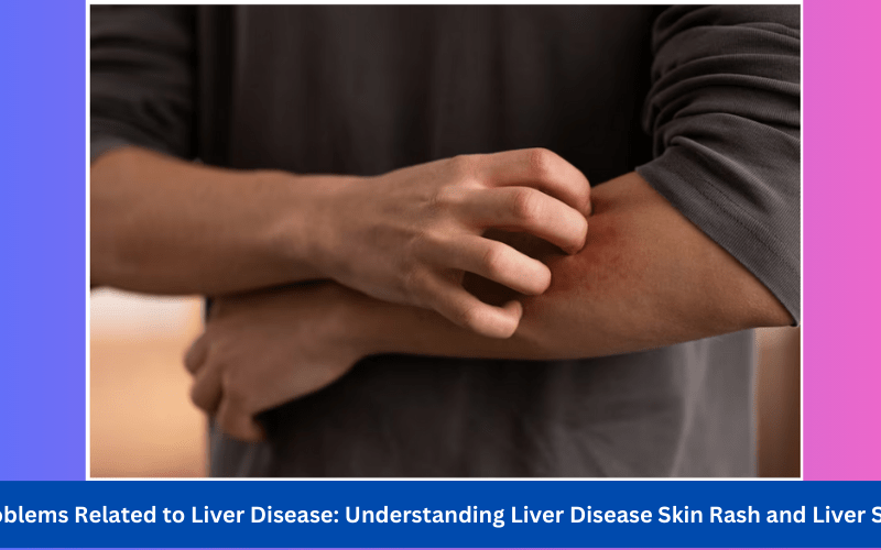skin-problems-related-to-liver-disease
