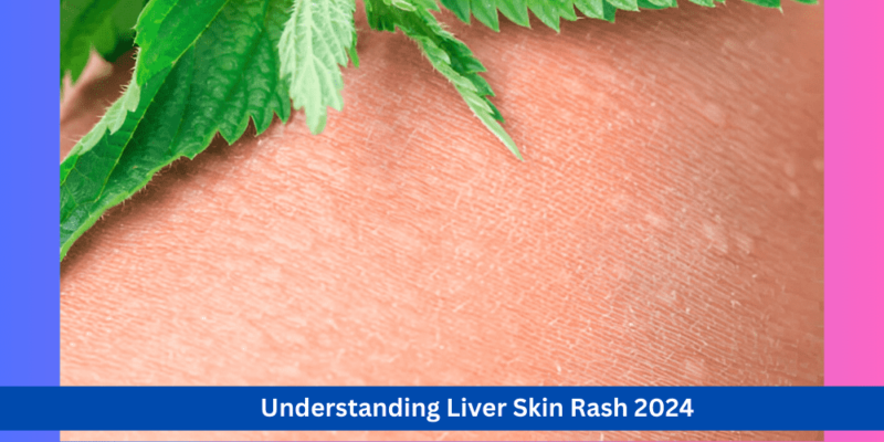 Understanding Liver Skin Rash: Causes, Symptoms, and Treatment Options