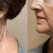 morpheus face treatment