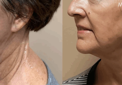 morpheus face treatment