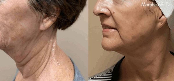 morpheus face treatment